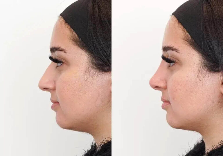 Non-Surgical Nose Jobs: Can They Help You Look Better?